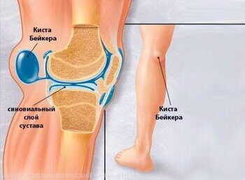 Боль в колене: причины, заболевания и лечение боли в колене